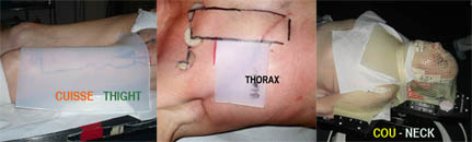 BOLUSIL ® applied to the thigh, chest and neck