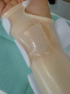 Orthosis with silicone on a wrist