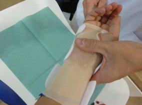 Orthèse de poignet avec plaque de silicone mise en place sur le patient