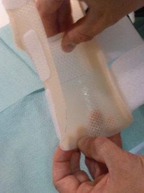 Plaque de silicone appliquée à la main sur l'orthèse